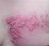 061017-herpes.jpg